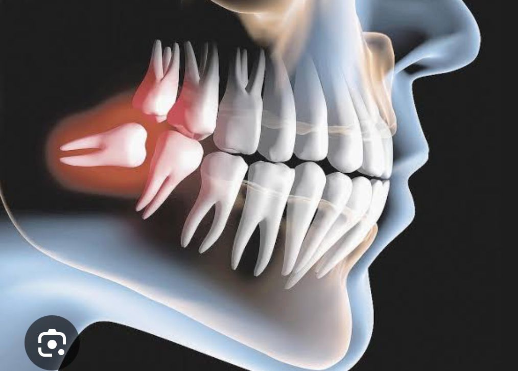 Por que é importante restaurar um dente após o tratamento de canal?