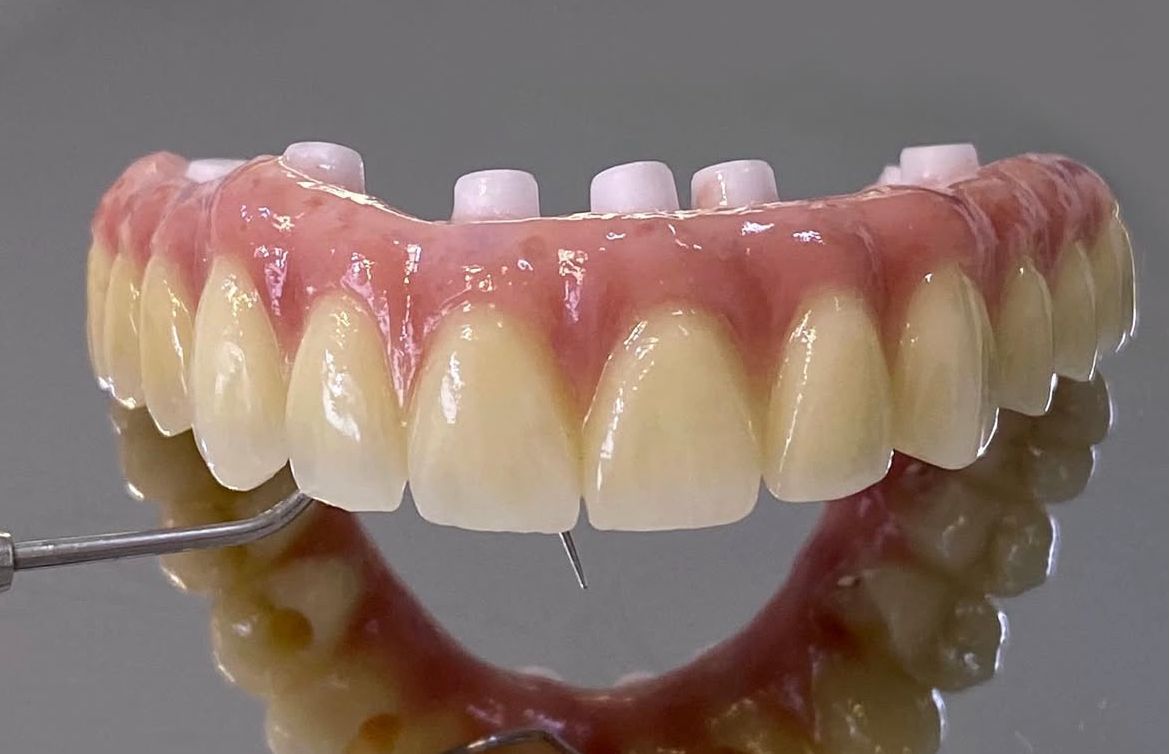 Implantes Dentários