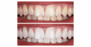 clareamento-dental-1024×529